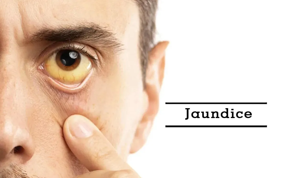 Jaundice Treatment Specialist in Pune, PCMC, Maharashtra  image 1