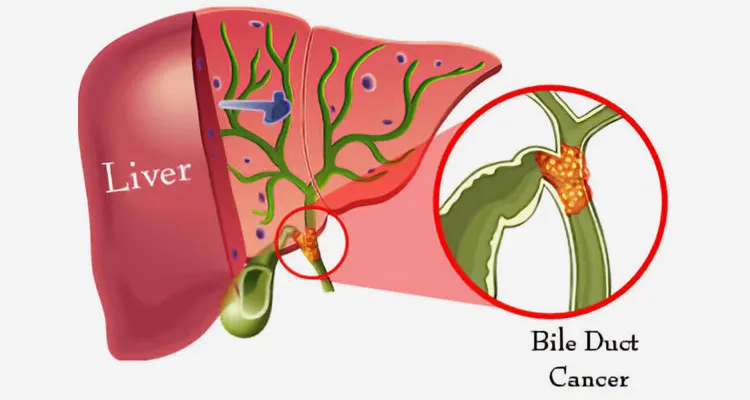 Bile Duct Cancer Treatment Specialist in Pune, PCMC Maharashtra  image 1