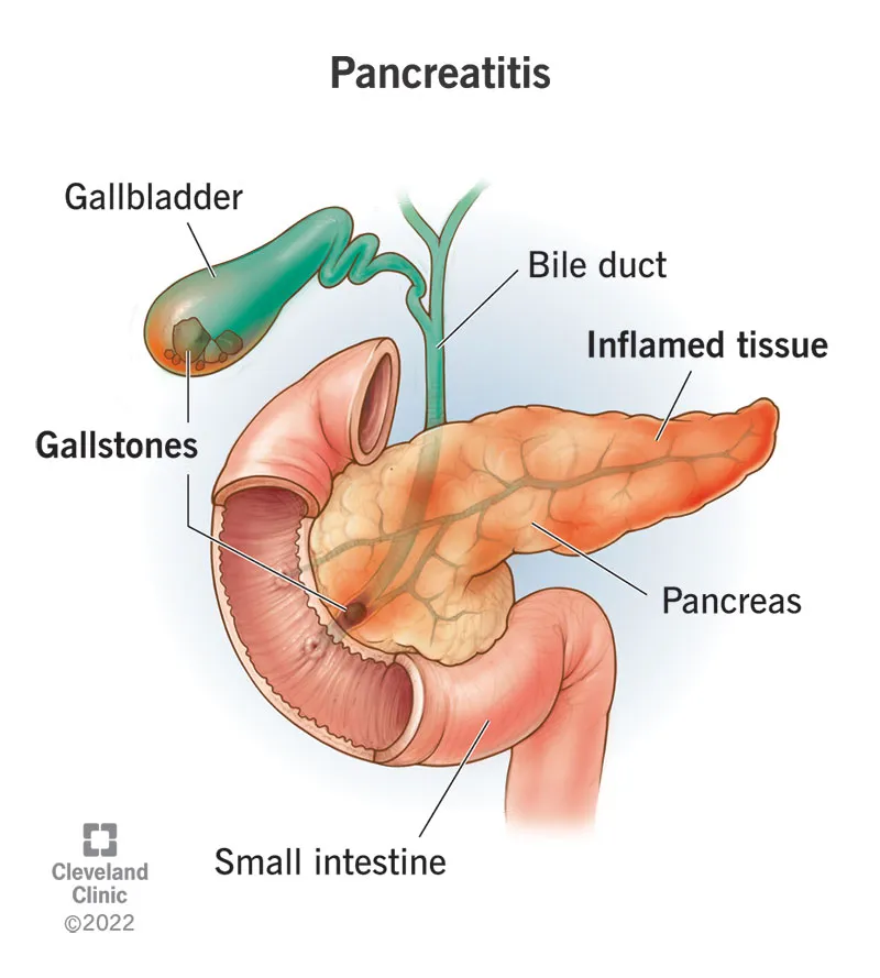 Pancreatitis Treatment Specialist in Pune, PCMC, Maharashtra  image 1