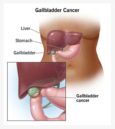 Gallbladder Cancer Treatment Specialist in Pune, PCMC, Maharashtra  image 1