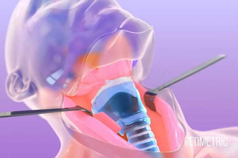 Voice Surgery for Vocal Cord Palsy image 1