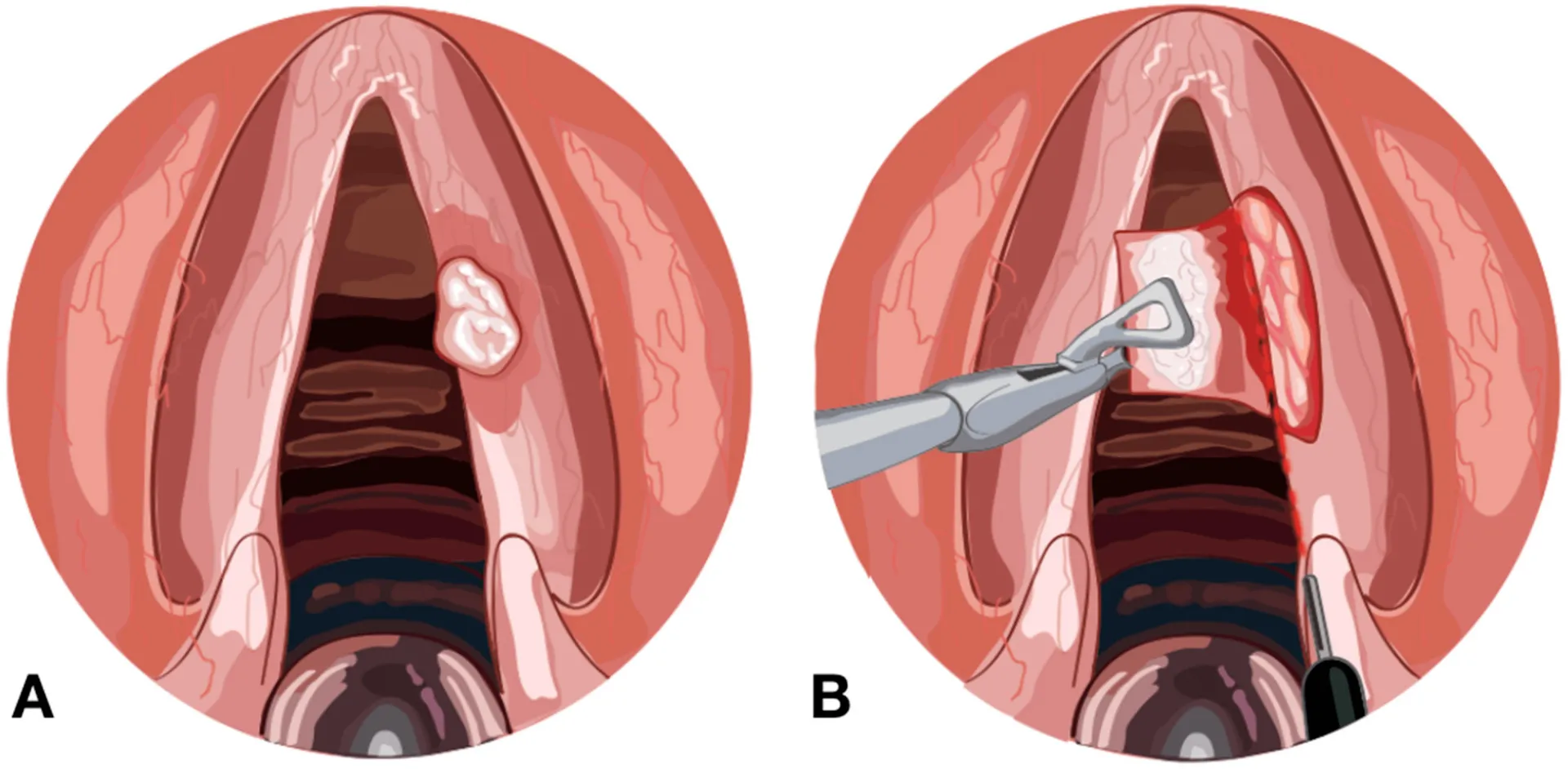 Microlaryngeal Surgery for Vocal Cord Swelling image 1