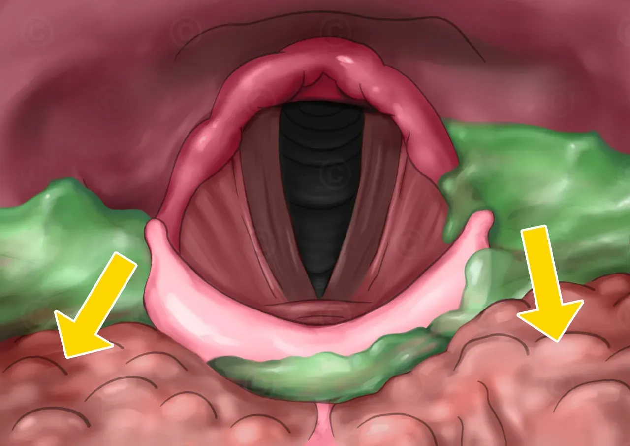Swallowing Treatment (Dysphagia Management) image 1