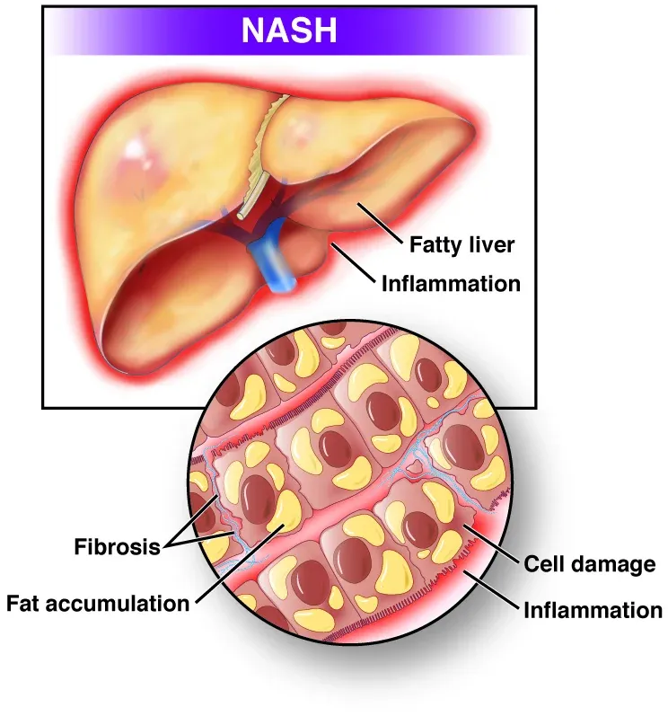 Nonalcoholic steatohepatitis (NASH) image 1