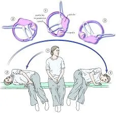 Canalith Repositioning (CR) image 1