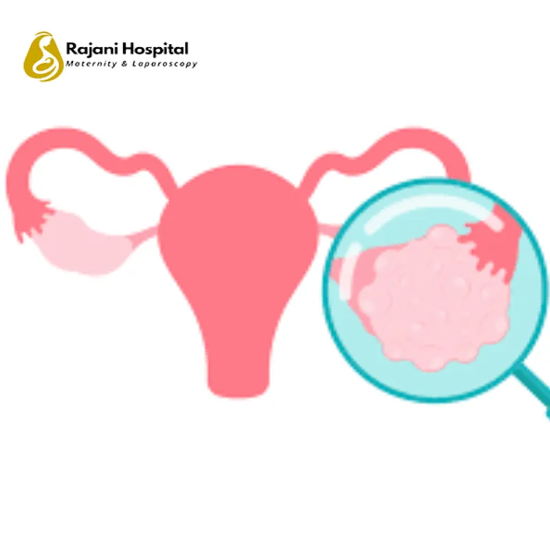 PCOD Treatment image 1