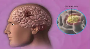 Brain Tumor Surgery image 1