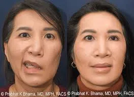 Surgery Of The Facial Nerve image 1