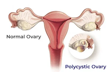 PCOD Treatment Doctor in Wakad,Hinjewadi,Pune image 1