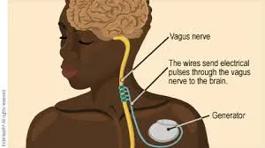 Vagus Nerve Stimulation ( Epilepsy ) image 1