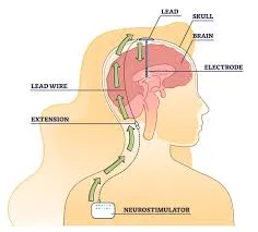 Deep Brain Stimulation Procedure image 1