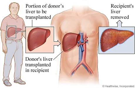 Liver Transplant Surgery | Best Liver Transplant Specialists in Mumbai India image 1