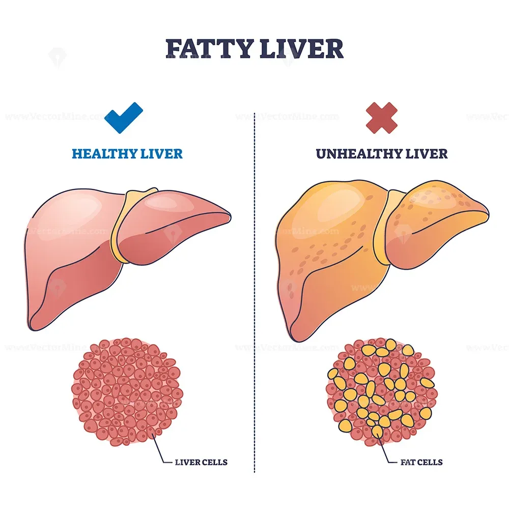 Fatty Liver Disease image 1