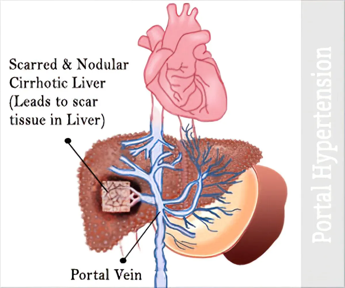 Portal hypertension image 1