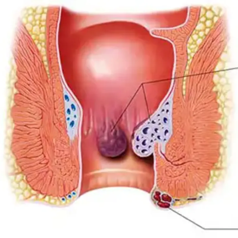 Piles Treatments image 1