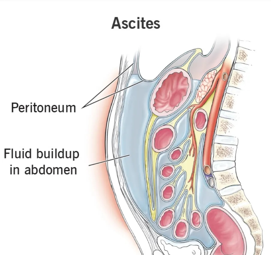 Ascites image 1