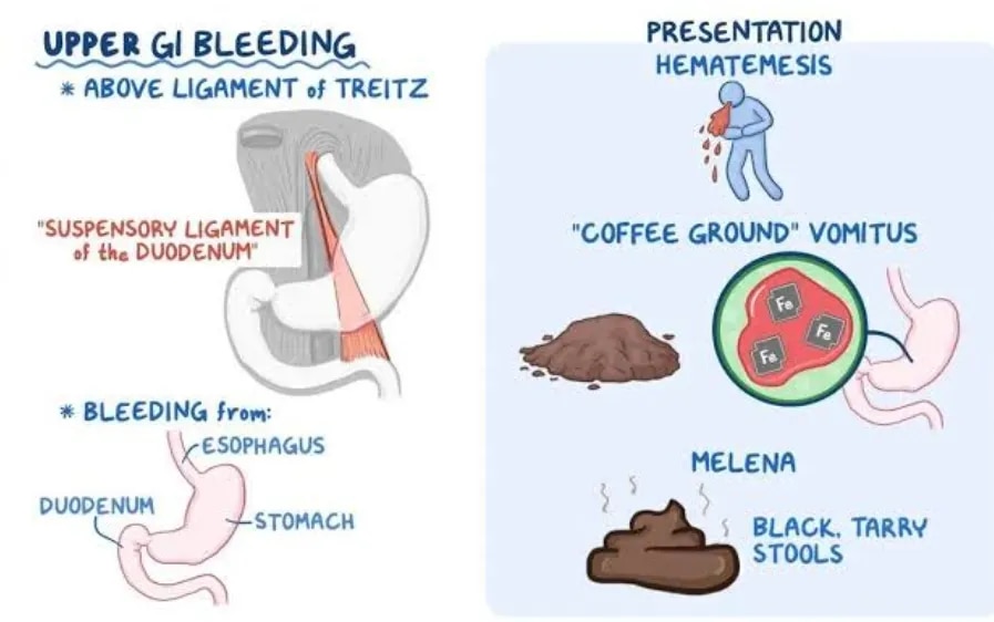 Variceal Bleeding & Melena Treatment | GI Bleed Management in Mumbai image 1