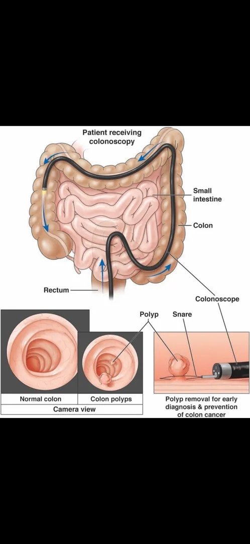 Colonoscopy image 1