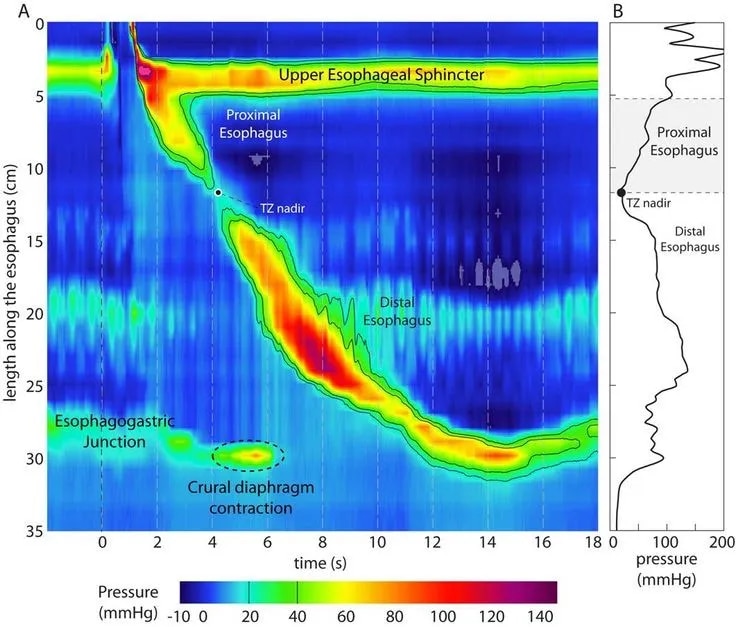 Esophageal Manometry image 1