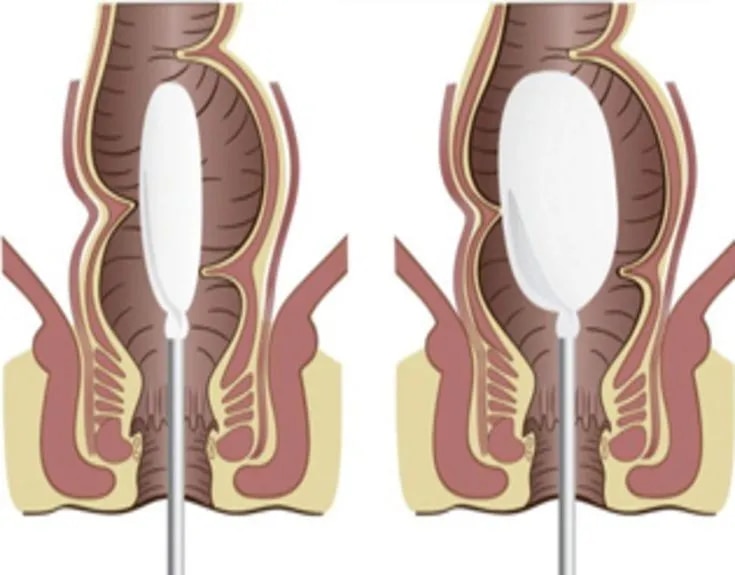 Anorectal Manometry image 1