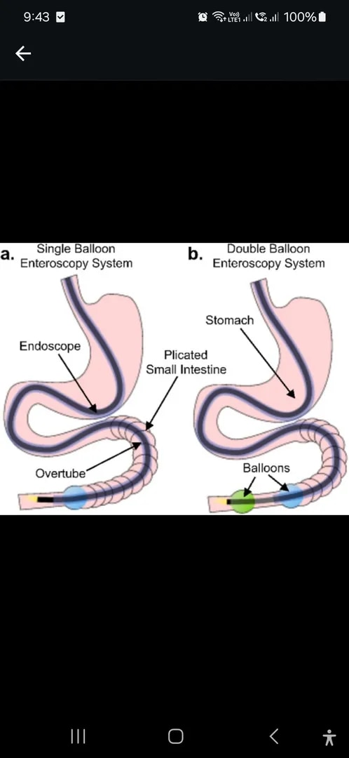 Enteroscopy image 1