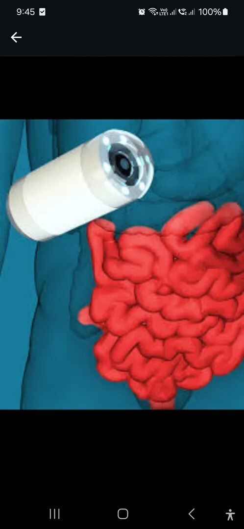 Capsule Endoscopy image 1