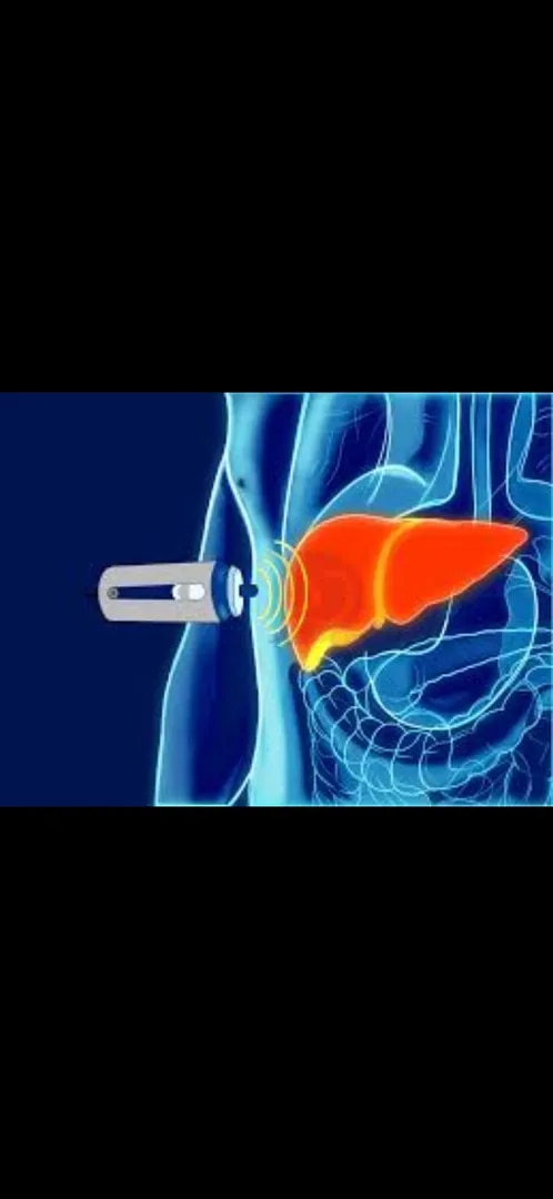 Fibroscan image 1
