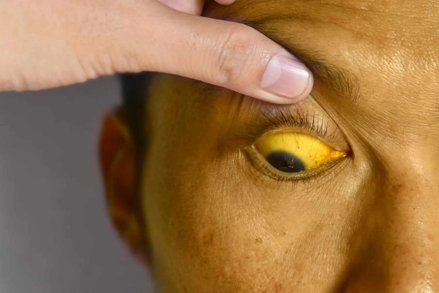 Jaundice Treatment | Expert Diagnosis & Liver Care in Mumbai image 1
