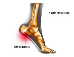  Plantar Fasciitis Physiotherapy Treatment image 1