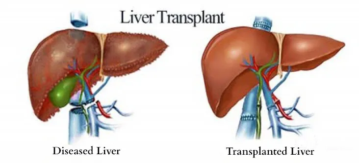Liver Transplant Consultation image 1