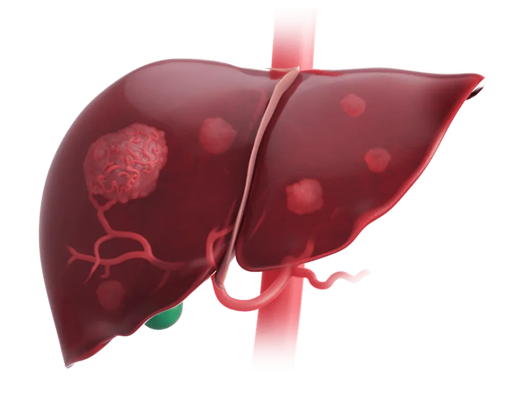  Liver Cancer (Hepatocellular Carcinoma) Diagnosis & Treatment image 1