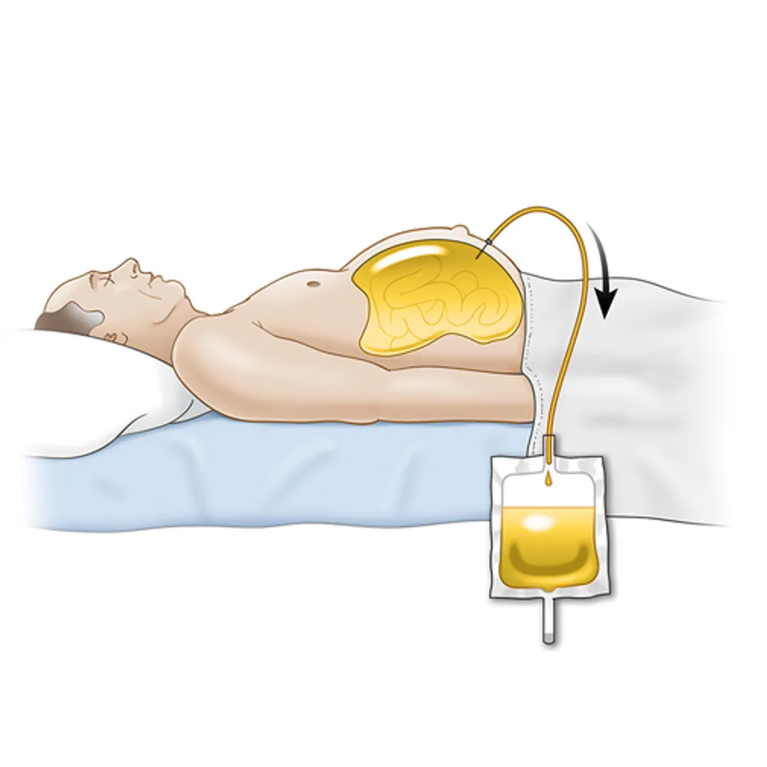 Ultrasound-Guided Paracentesis for Ascites Management in Liver Cirrhosis” image 1