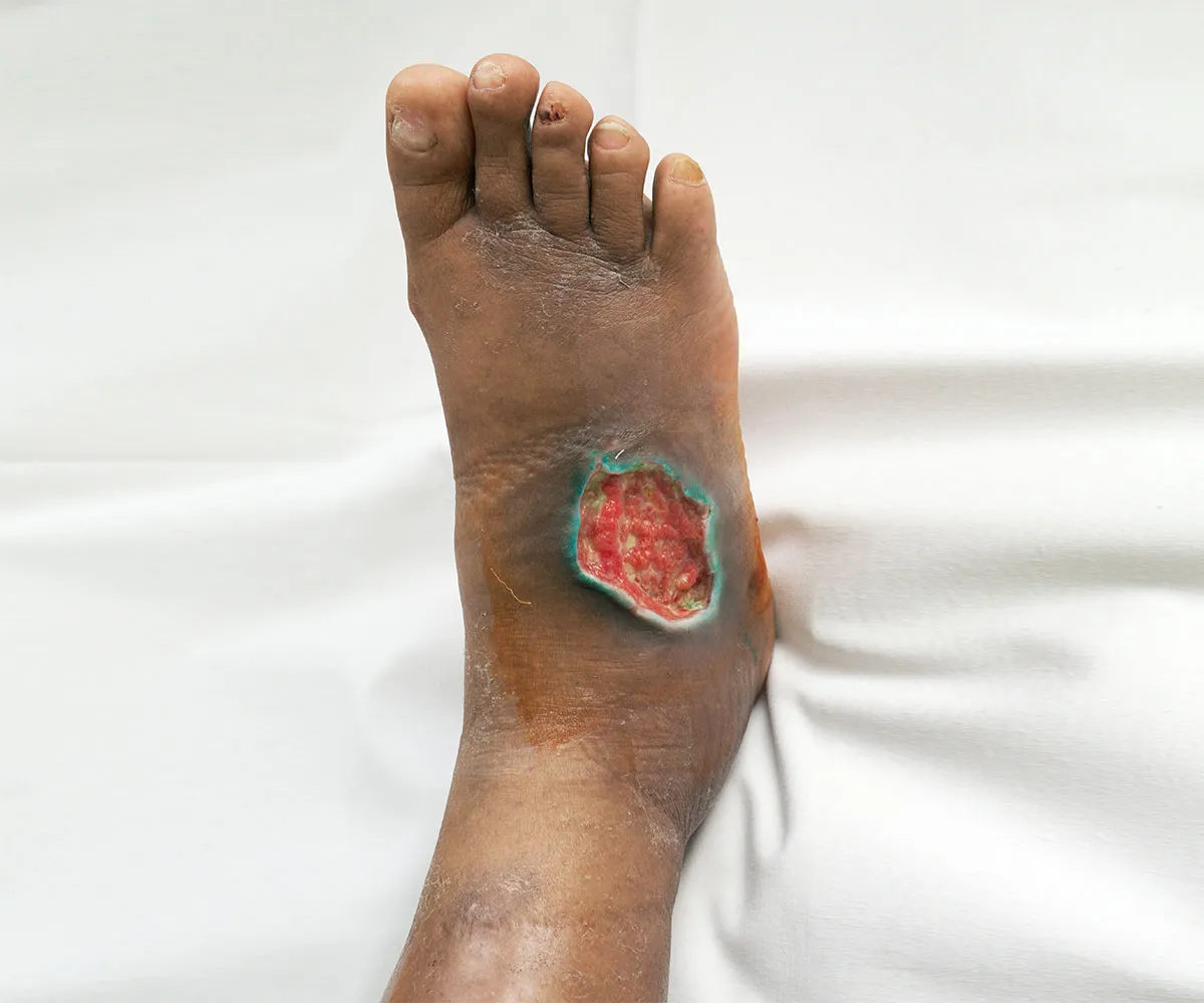 Leg Ulcer Management image 1