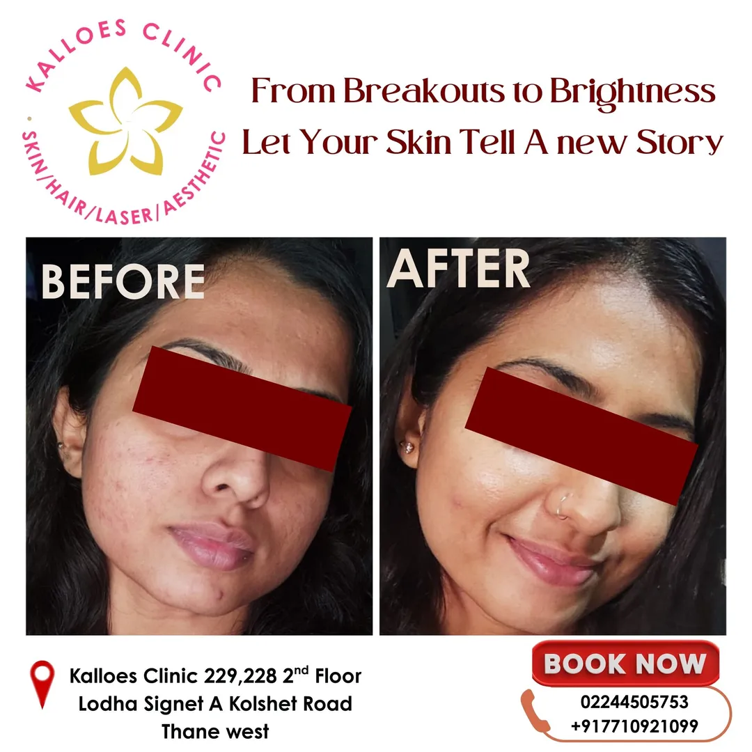 Acne / Acar Scar treatment image 1