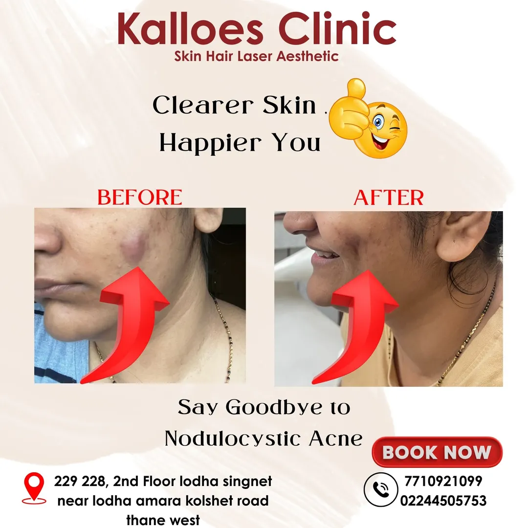 Acne / Acar Scar treatment image 2