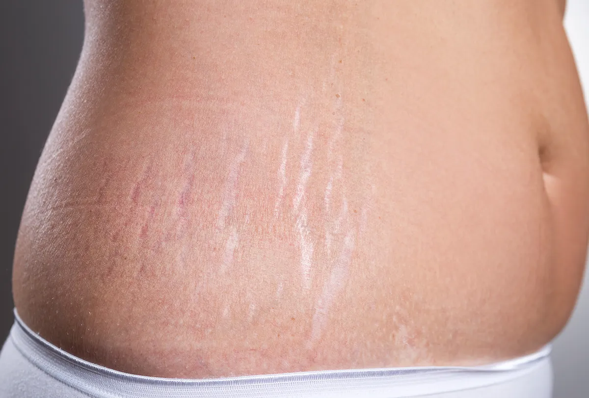  stretch mark removal image 1