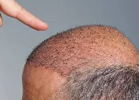 Hair Transplantation image 1