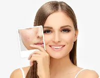 Acne and Acne Scars image 1