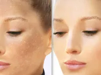 Uneven Skin tone Treatment in Coimbatore image 1