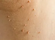 Skin Tag Removal Treatment in Coimbatore image 1