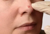 Mole Removal Clinic in Coimbatore image 1