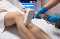 Laser Hair Removal Treatment Coimbatore image 1