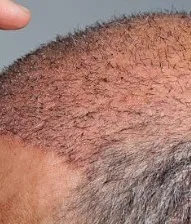Hair Transplantation Clinic in Coimbatore  image 1