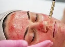 Vampire Facial Clinic in Coimbatore image 1