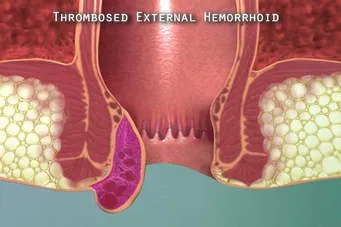 LASER SURGERY FOR PILES  image 1