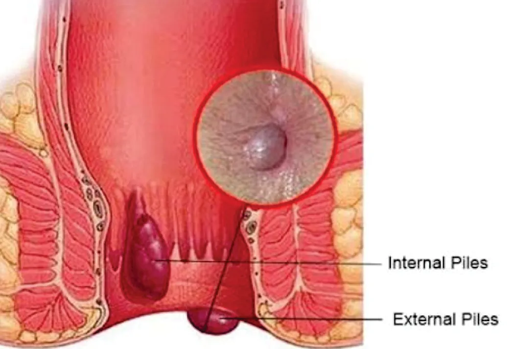 LASER SURGERY FOR PILES  image 2