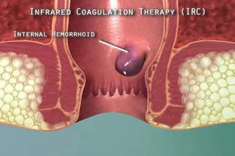 LASER SURGERY FOR PILES  image 3