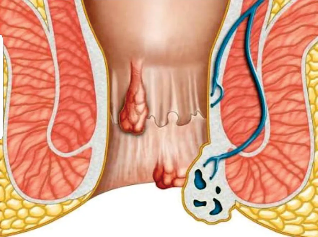 LASER SURGERY FOR PILES  image 4