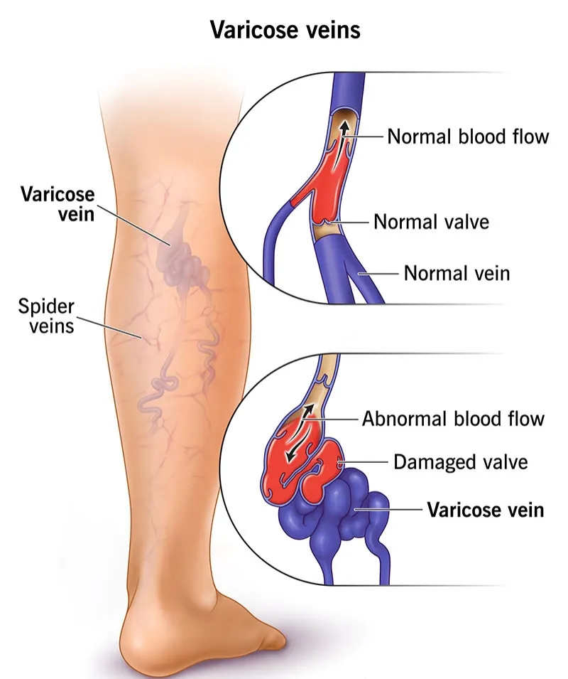 Varicose Veins Treatment Specialist in Wakad, PCMC Pune  image 1