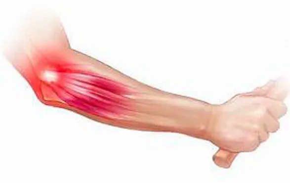 Non-Surgical, Drug-Free Relief for Tennis Elbow in Pune image 1